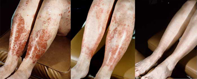 Psoriasis with Accompanying psoriatic Arthritis Examples